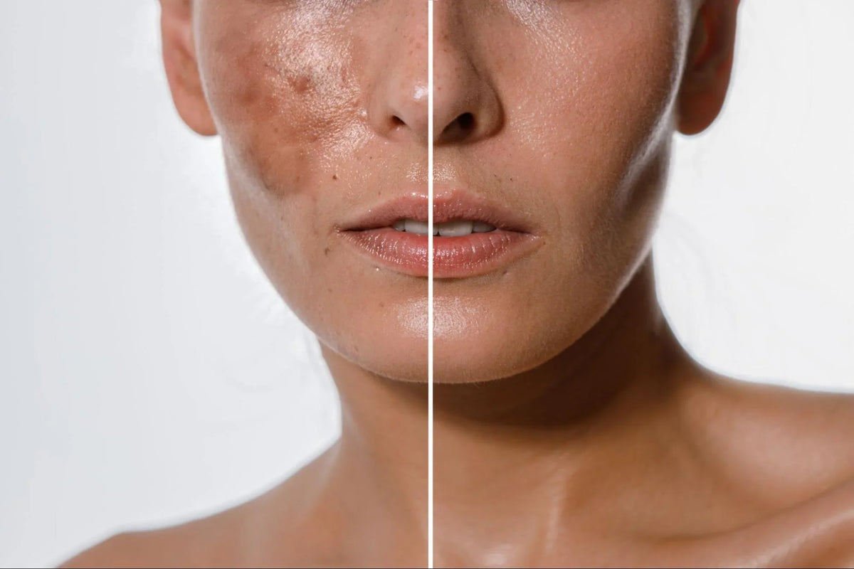 Pigmentation
