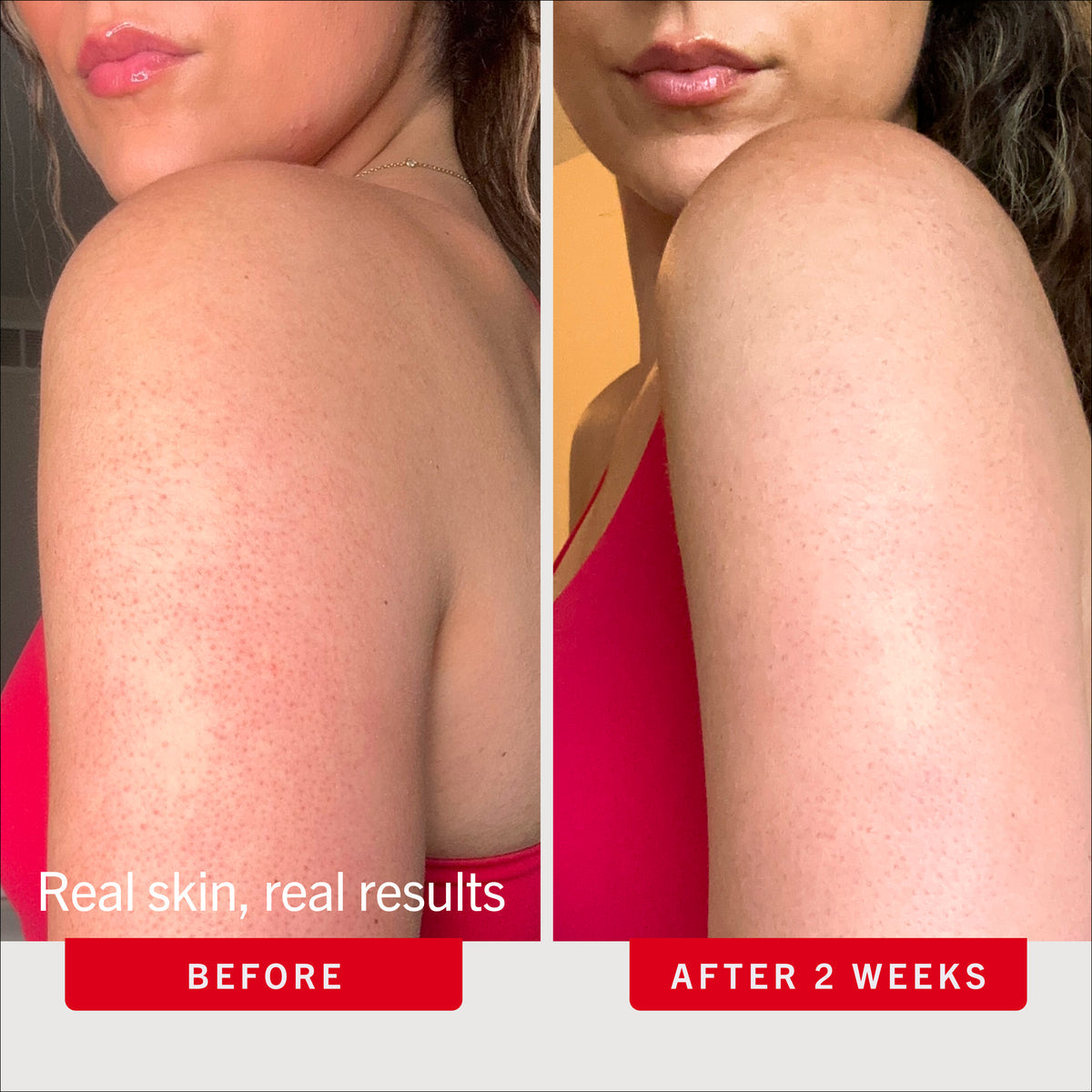 First Aid Beauty Bye Bye Bumps KP Set